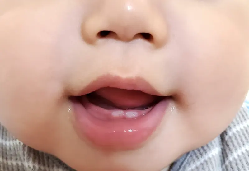 乳歯が生え始めたら